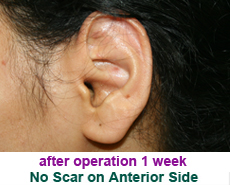 plastic-surgery-prominent-ear 